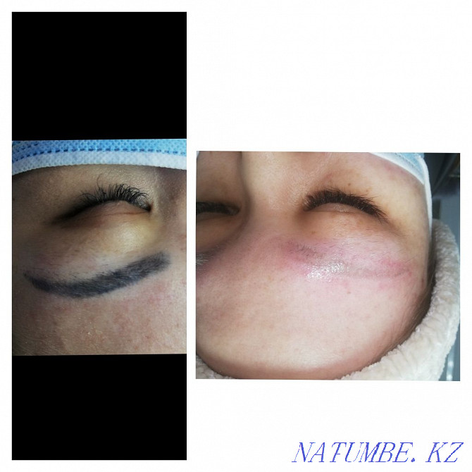 3000 tattoo removal and laser tattoo removal with 50% Astana - photo 1
