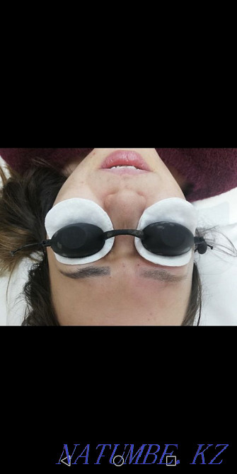 3000 татуировканы алып тастау және лазерлік татуировканы 50% алып тастау  Астана - изображение 4