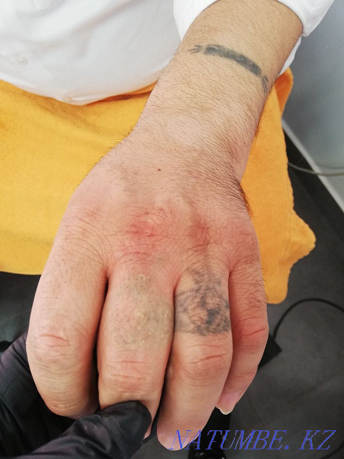 3000 татуировканы алып тастау және лазерлік татуировканы 50% алып тастау  Астана - изображение 6