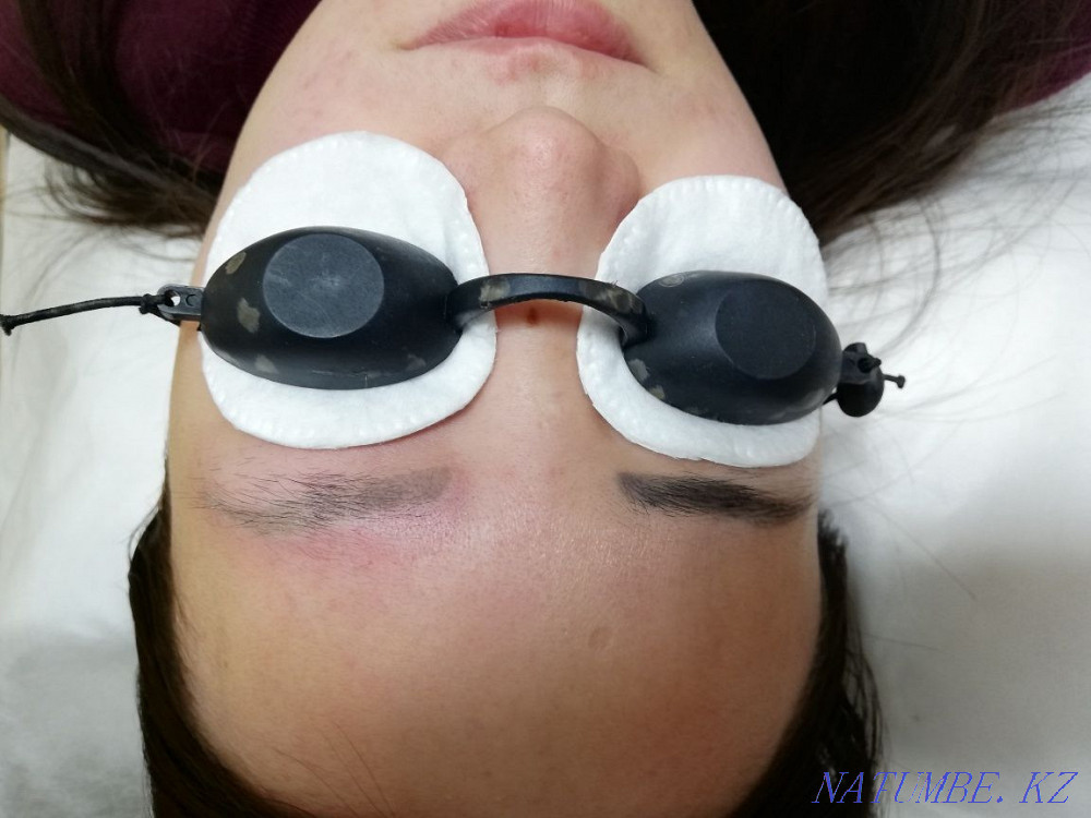 3000 татуировканы алып тастау және лазерлік татуировканы 50% алып тастау  Астана - изображение 2