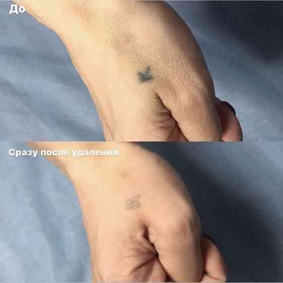 Лазерное удаление татуажа и татуировок  Павлодар 