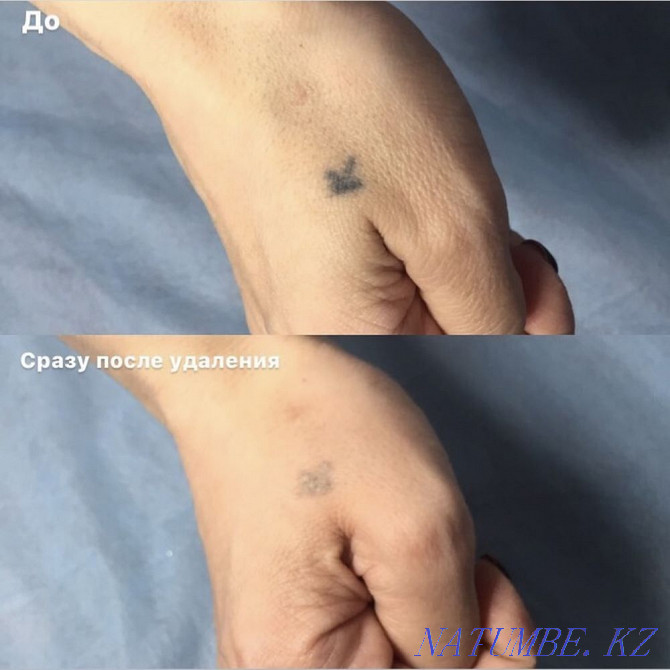Laser tattoo and tattoo removal Pavlodar - photo 3