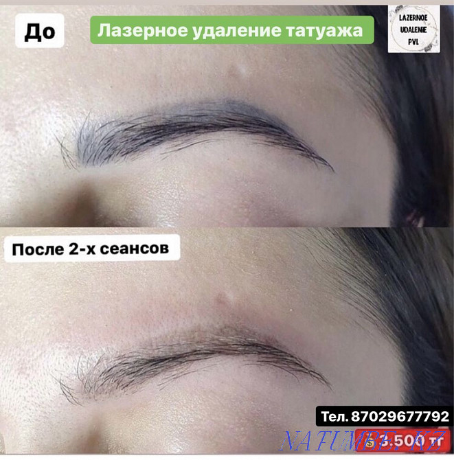 Laser tattoo and tattoo removal Pavlodar - photo 1