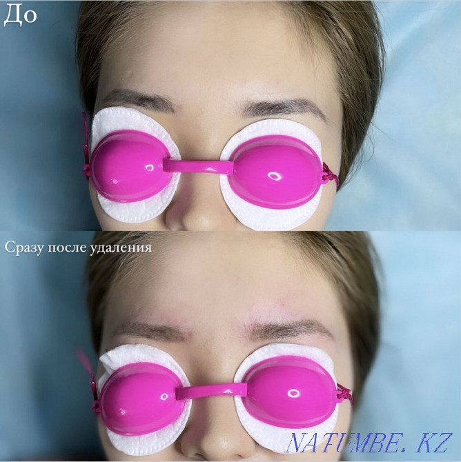 Laser tattoo and tattoo removal Pavlodar - photo 4