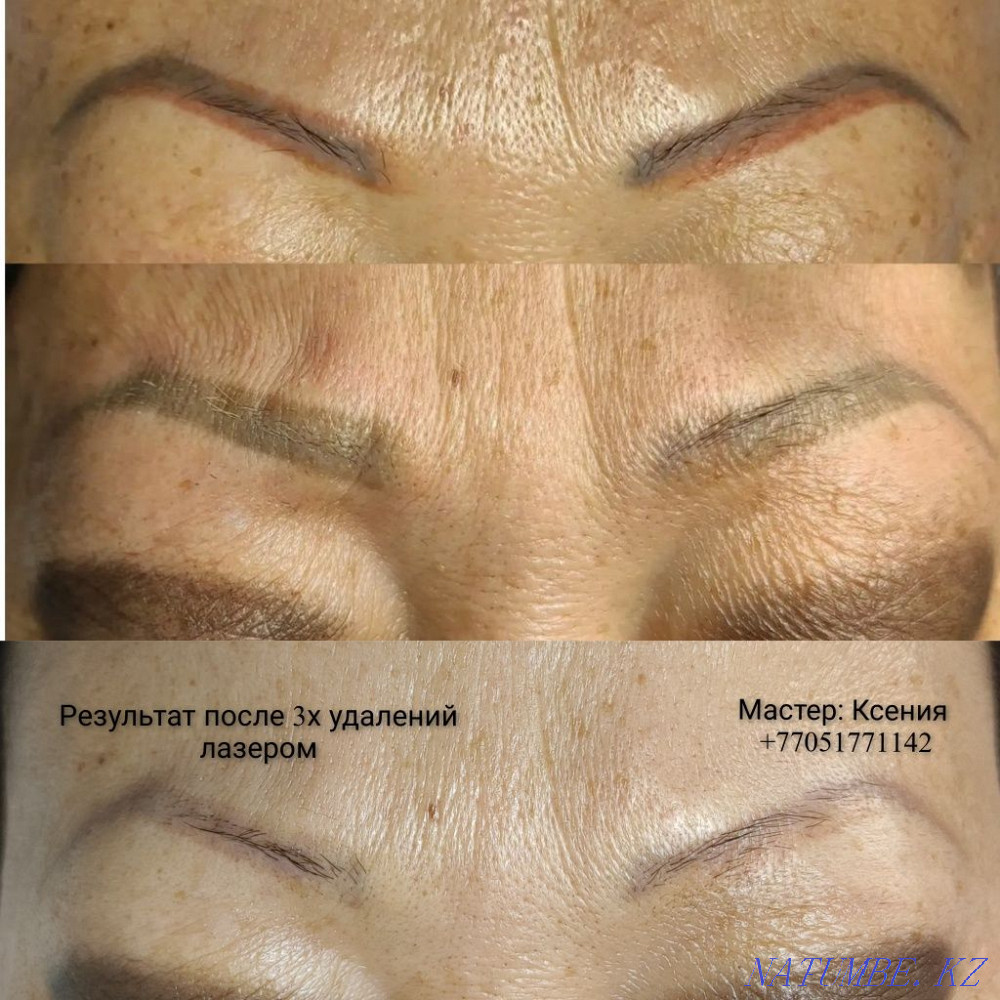 Удаление татуажа и тату Муратбаев - изображение 2