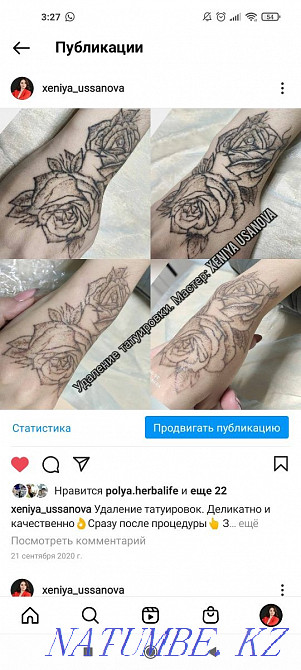 Удаление татуажа и тату Муратбаев - изображение 6