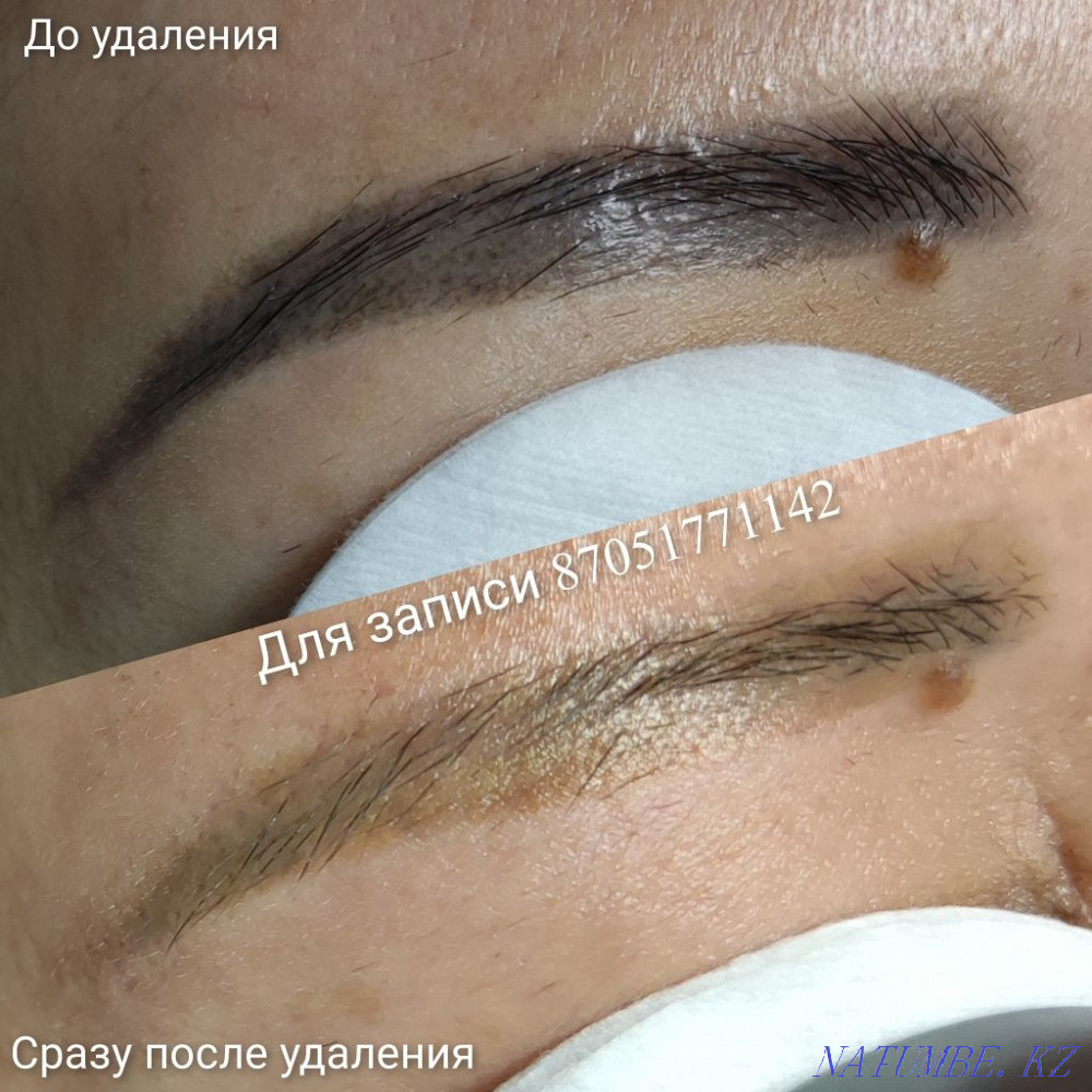 Удаление татуажа и тату Муратбаев - изображение 3