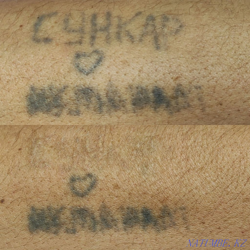 Удаление татуажа и тату Муратбаев - изображение 1