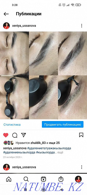 Удаление татуажа и тату Муратбаев - изображение 7