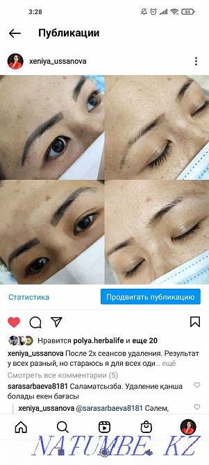 Удаление татуажа и тату Муратбаев - изображение 8