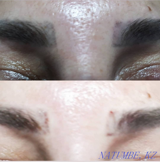 Удаление старого или некачественного татуажа Ремувером Темиртау - изображение 7