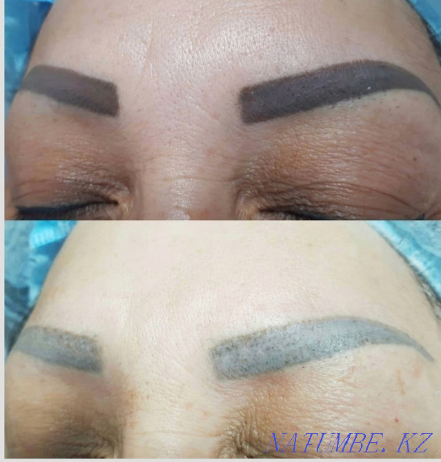 Удаление старого или некачественного татуажа Ремувером Темиртау - изображение 6