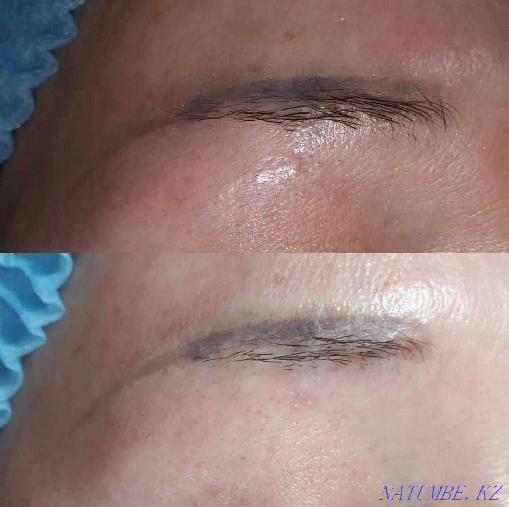 Удаление старого или некачественного татуажа Ремувером Темиртау - изображение 5