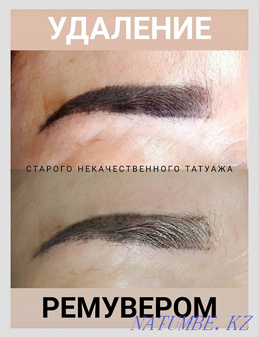 Удаление старого или некачественного татуажа Ремувером Темиртау - изображение 1