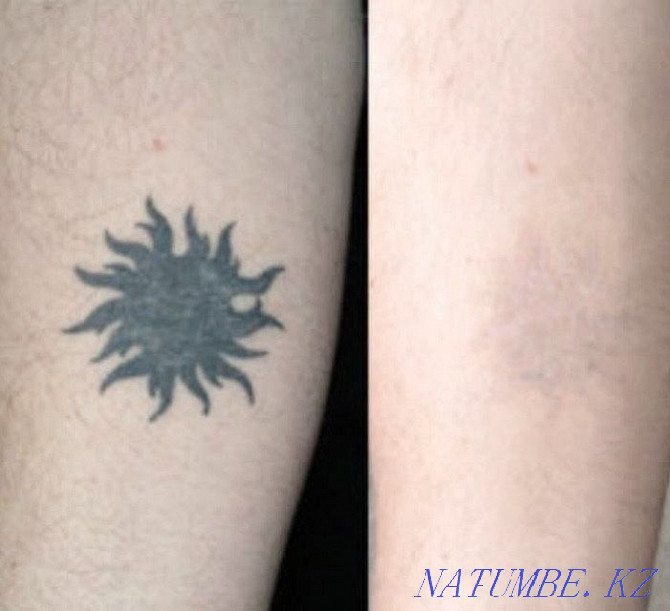 Removing an old tattoo with a remover Almaty - photo 6