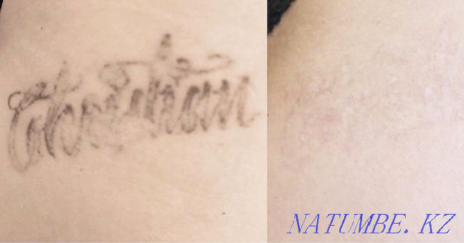 Removing an old tattoo with a remover Almaty - photo 7