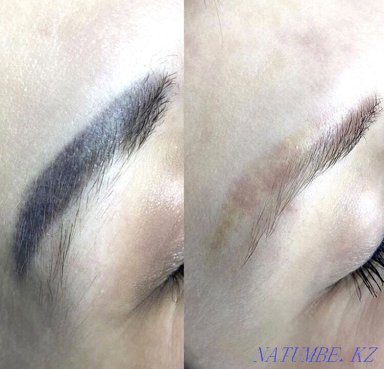 Удаление старого татуажа ремувером Алматы - изображение 5