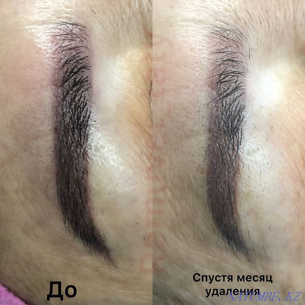 Удаление старого татуажа ремувером Алматы - изображение 2