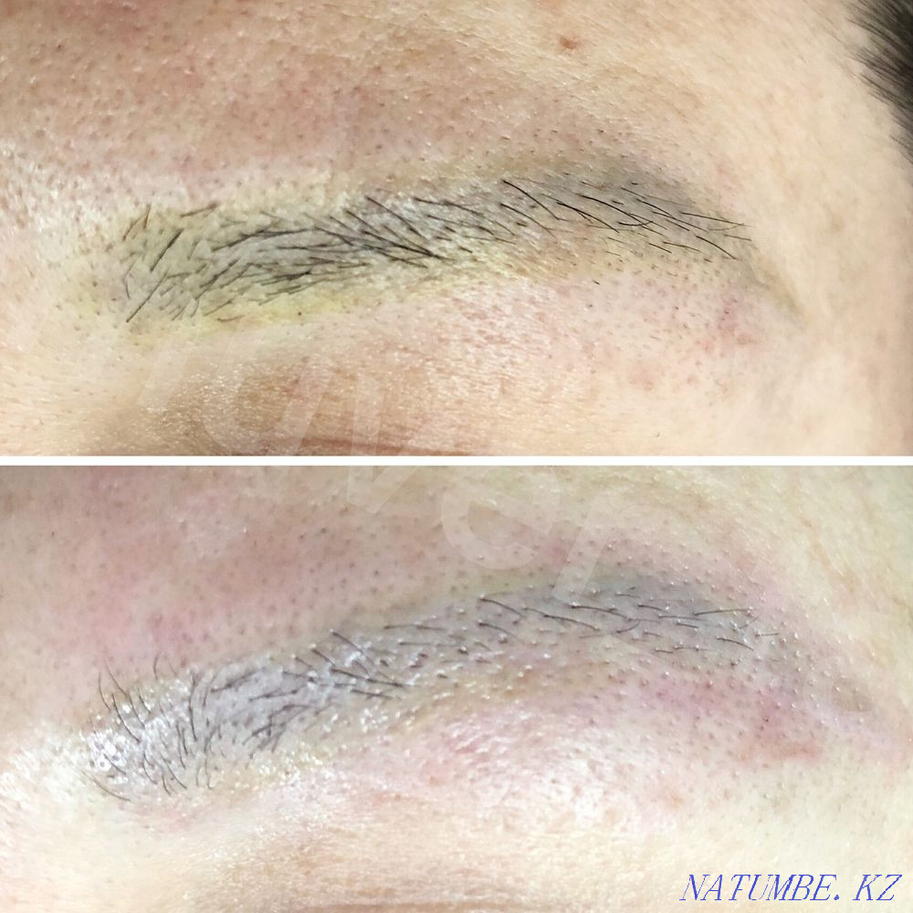 Удаление старого татуажа ремувером Алматы - изображение 1