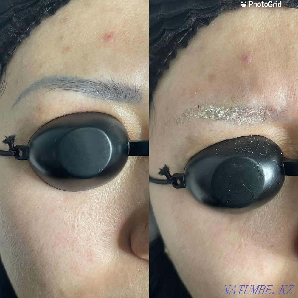 Лазерное удаление татуажа Астана - изображение 1