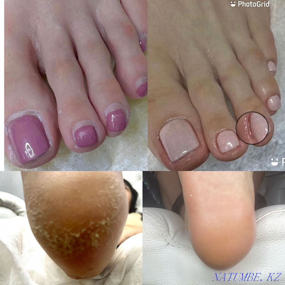 Лазерное удаление татуажа Астана - изображение 2