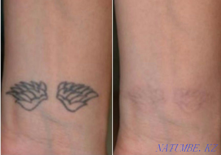 удаление татуировок,татуажа,пм Астана - изображение 1