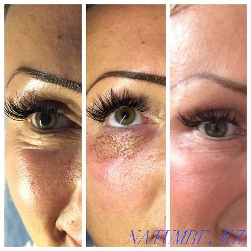 Plasma lift 15000 non-surgical blepharoplasty Almaty - photo 2