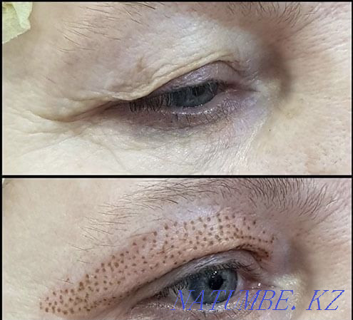 Plasma lift 15000 non-surgical blepharoplasty Almaty - photo 1