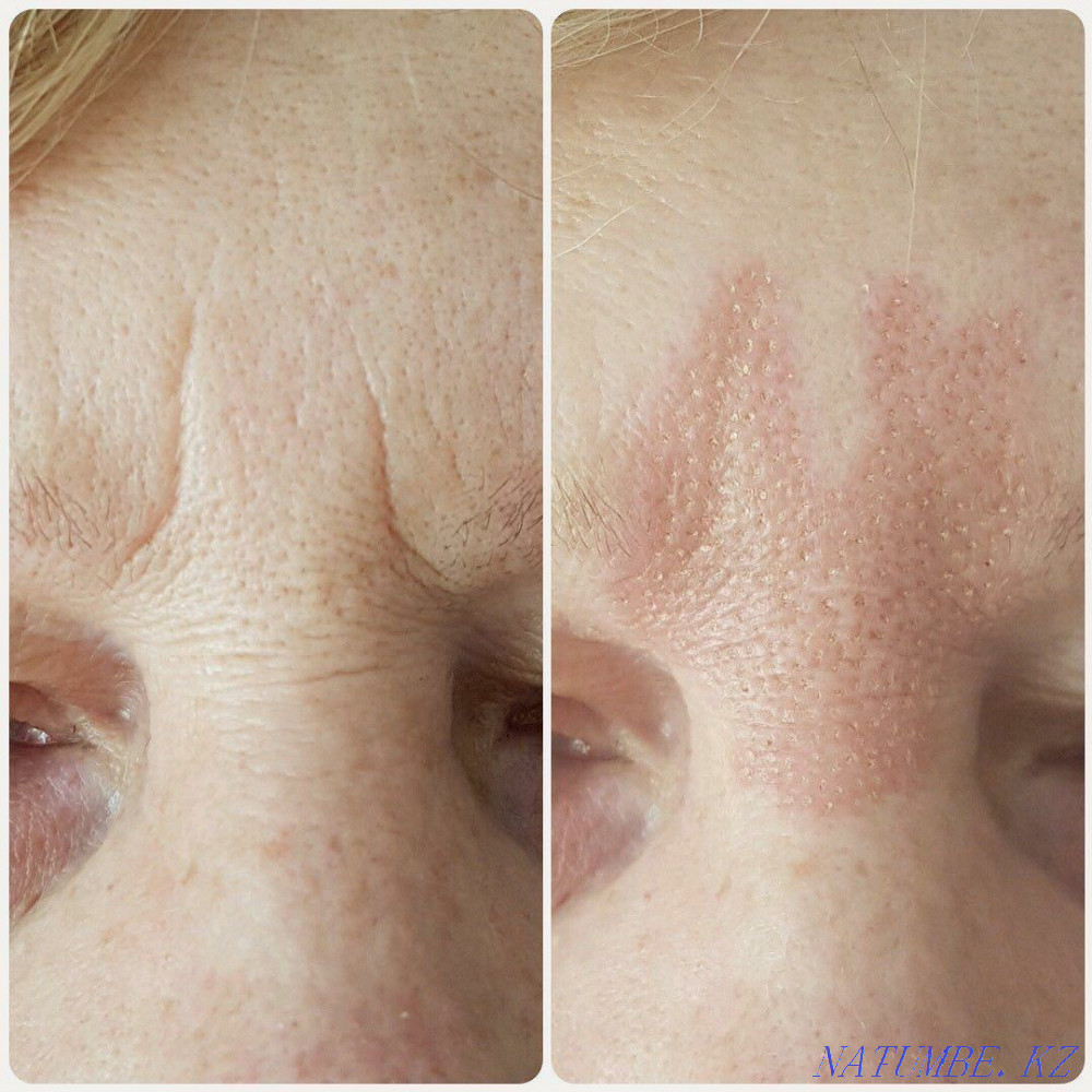 Plasma lift 15000 non-surgical blepharoplasty Almaty - photo 7