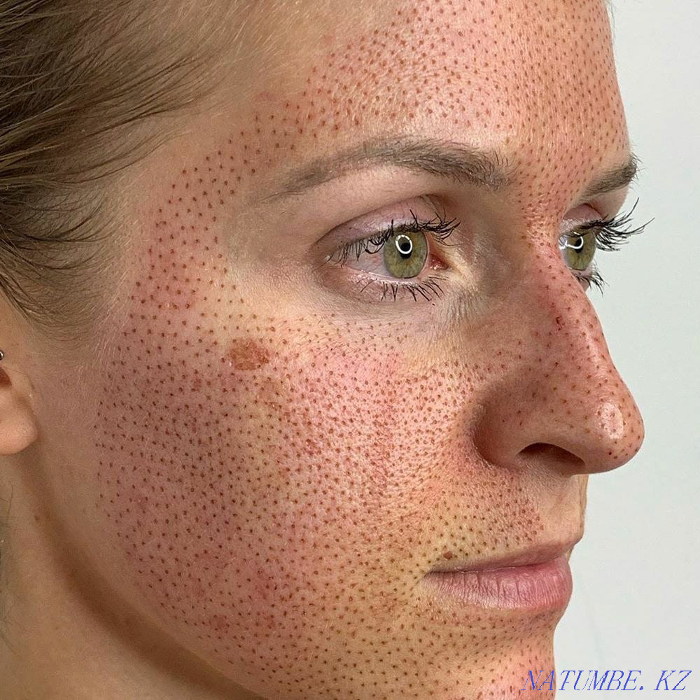 Plasma lift 15000 non-surgical blepharoplasty Almaty - photo 8