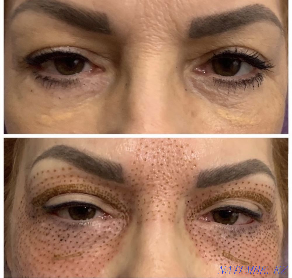 Plasma lift 15000 non-surgical blepharoplasty Almaty - photo 3