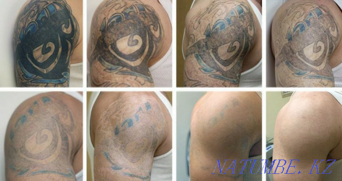 Лазерное удаление перманентного макияжа а так же тату Атырау - изображение 2