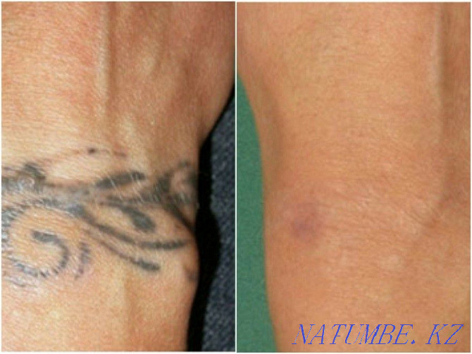 Laser removal of permanent make-up and tattoos Atyrau - photo 3