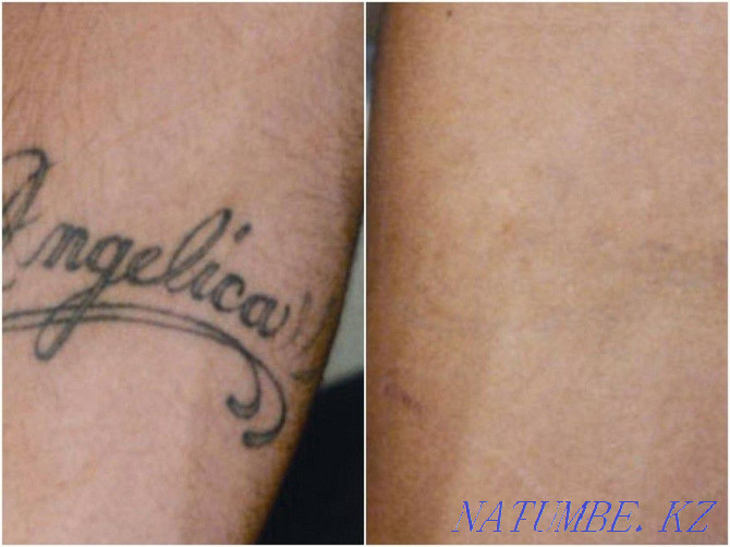 Laser removal of permanent make-up and tattoos Atyrau - photo 1