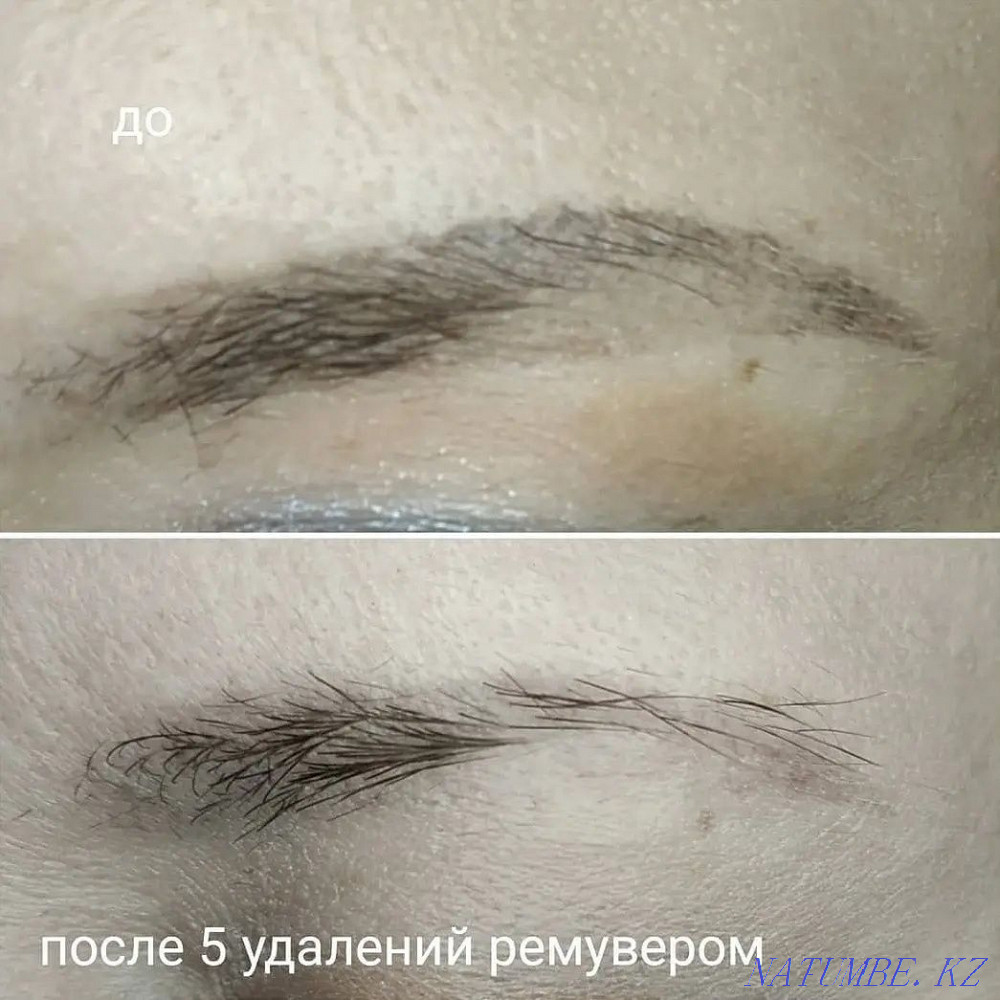 Laser tattoo removal, tattoo removal Astana - photo 1