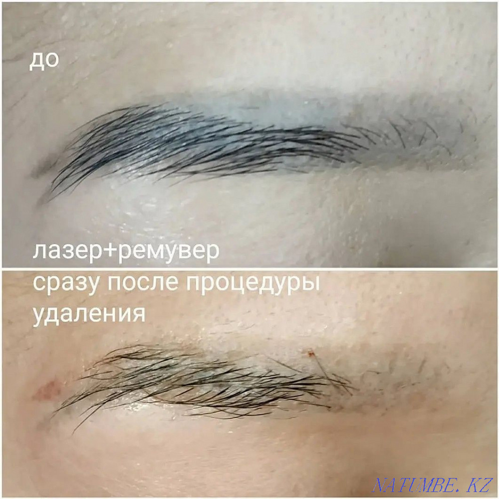 Laser tattoo removal, tattoo removal Astana - photo 3