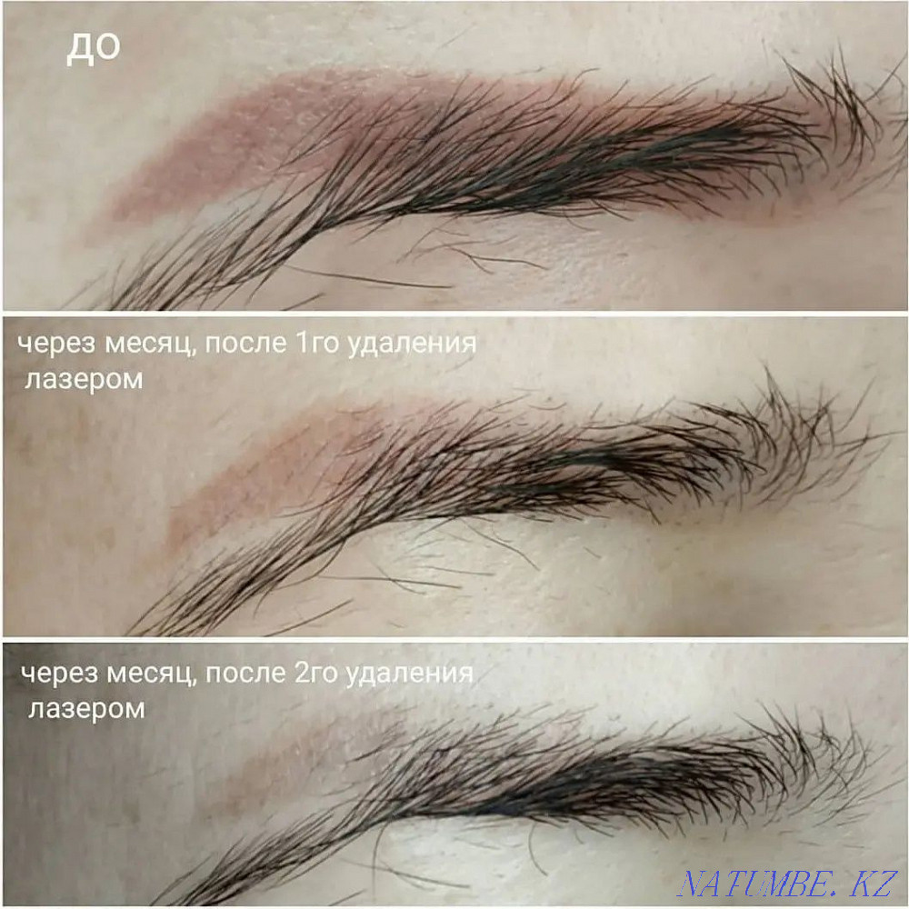 Laser tattoo removal, tattoo removal Astana - photo 4