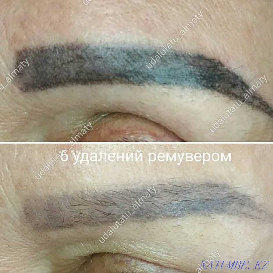 Татуировка қасы ерін көрсеткілері мен татуировканы алып тастау. Жоюшы, лазер  Астана - изображение 1