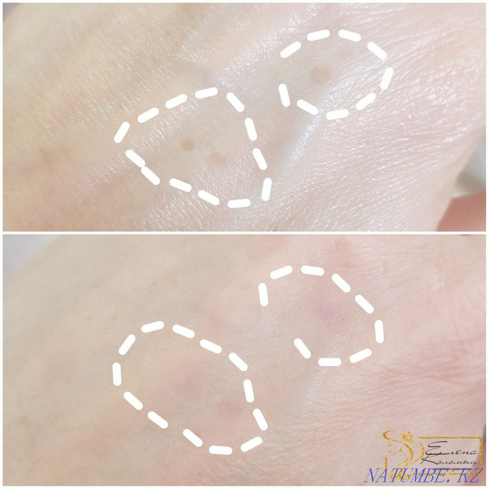 Татуировка қасы ерін көрсеткілері мен татуировканы алып тастау. Жоюшы, лазер  Астана - изображение 4