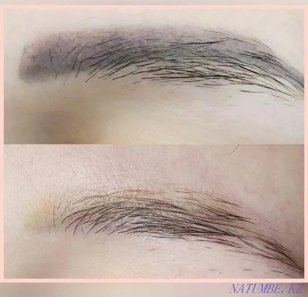 Удаление ремувером некачественного татуажа Алматы - изображение 5