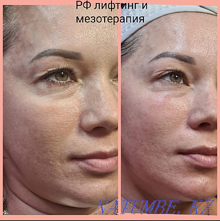 Cosmetologist. Ultrasound cleaning. RF lifting. Mesotherapy. Carboxytherapy. Oxygeneo Ust-Kamenogorsk - photo 4
