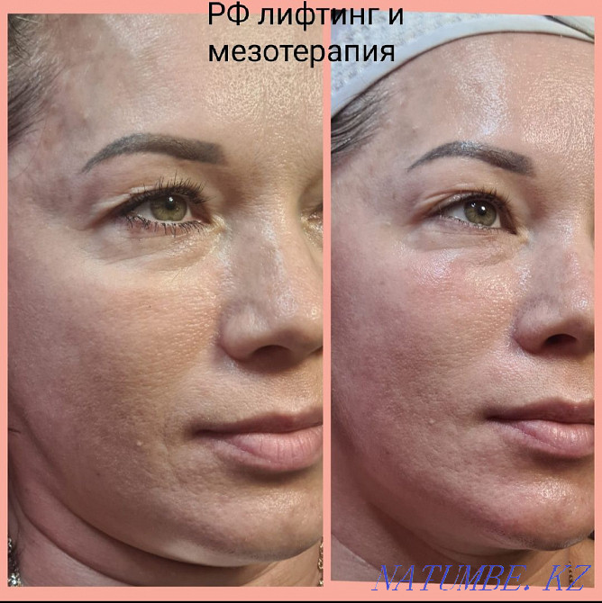 Cosmetologist. Ultrasound cleaning. RF lifting. Mesotherapy. Carboxytherapy. Oxygeneo Ust-Kamenogorsk - photo 4