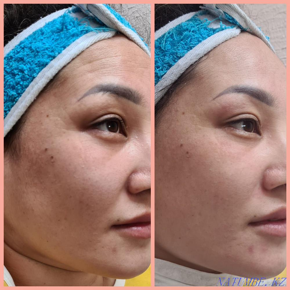 Cosmetologist. Ultrasound cleaning. RF lifting. Mesotherapy. Carboxytherapy. Oxygeneo Ust-Kamenogorsk - photo 2