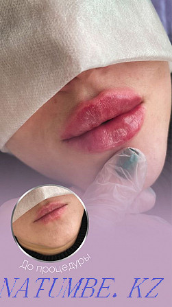 Lip augmentation, botox, hyperhidrosis, facial cleansing Almaty - photo 1