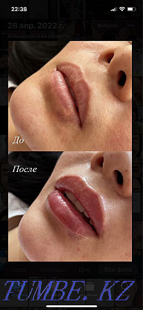 Lip augmentation, botox, hyperhidrosis, facial cleansing Almaty - photo 2