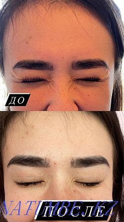 Lip augmentation, botox, hyperhidrosis, facial cleansing Almaty - photo 4