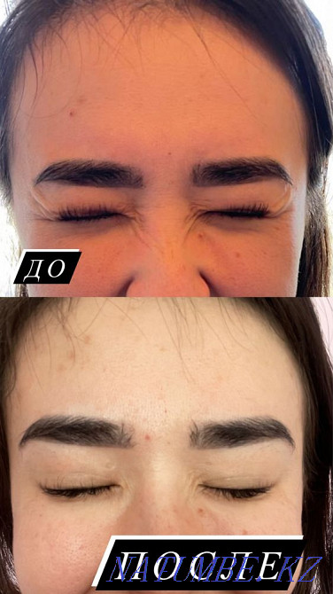 Ерін үлкейту, ботокс, гипергидроз, бет тазарту  Алматы - изображение 4