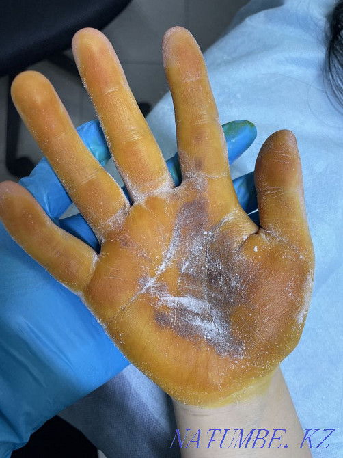 Ерін үлкейту, ботокс, гипергидроз, бет тазарту  Алматы - изображение 3