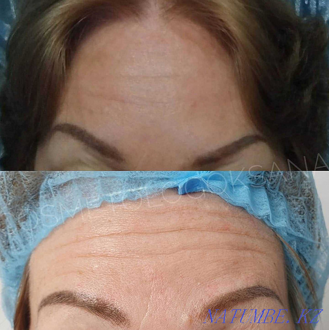 Косметолог в Актау .Увеличение губ. Актау - изображение 4