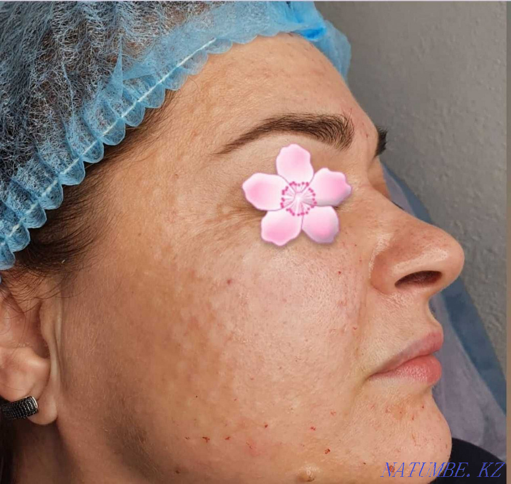 Косметолог в Актау .Увеличение губ. Актау - изображение 2